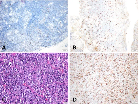 Figure 2. Images of Ki-67 index in case5 and diffuse large B cell lymphoma transformed case