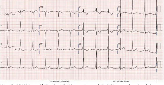 Fig.  1.  ECG  in  a  Patient  with  Excercise  related  Syncopal  episode: