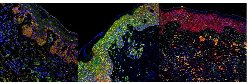 Figure 3. Double immunofluorescence staining of (A) melan-A and CD200 (melan-A, red; CD200, green), (B) melan-A and COX-2 (melanA, red; 