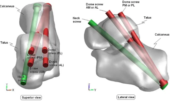 Fig. 1. Four fixation configurations for double-screw subtalar arthrodesis: Neck  screw + Dome screw(AL), Neck screw + Dome screw(AM), Neck screw + Dome screw(PL),  Neck screw + Dome screw(PM)