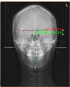 그림 4. 각도를 기준으로 측정한 안면비대칭이 없는 환자