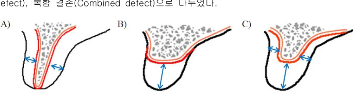 Fig. 1. Classification of defect type - Cologne Classification of Alveolar Ridge Defect.