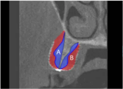 Fig. 3. Shrinkage rate(Area) is defined as bone resorption divided by sum of bone gain and bone resorption.