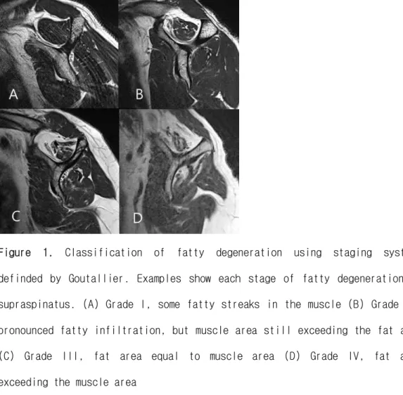 Figure  1.  Classification  of  fatty  degeneration  using  staging  systems  definded  by  Goutallier