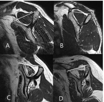 Figure 2. Grading for muscle atrophy based on a T1-weighted oblique sagittal  MR image