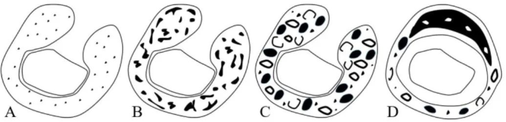 Figure 1  Schematic drawings of the four types of calcification patterns in the  TMJ (A) stippled type, (B) flocculent type, (C) ring-and-arc type, and (D)  popcorn type