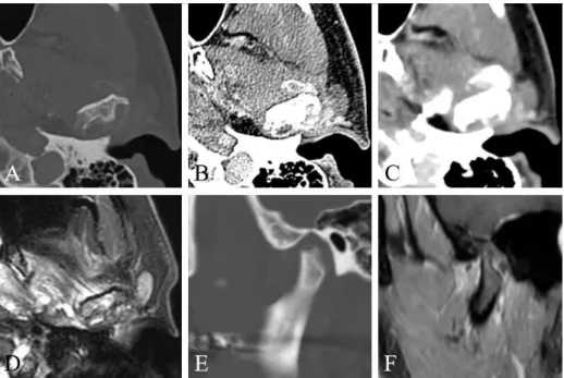 Figure 7 A 52-year-old man complaining pain on the left TMJ. (A–D) Axial  MDCT and fat-suppressed T2-weighted MR images show a mass surrounding  and destructing the mandibular condyle