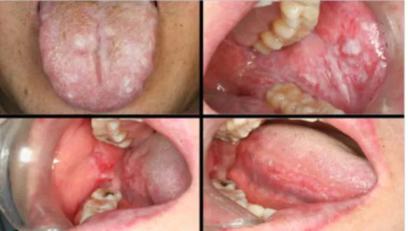 Figure 1. Oral lichen planus involving the buccal mucosa and tongue. 