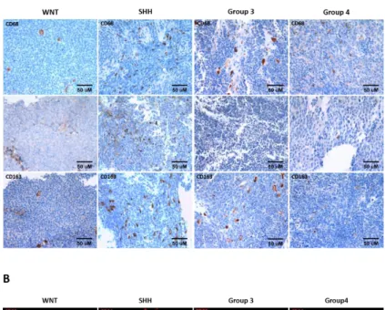 Figure  3.  TAM  recruitment  across  MB  subgroups.  (A)  Representative  CD68,  CD86, CD163 IHC images in WNT (n = 3), SHH (n = 23), Group 3 (n = 2) and  Group  4  (n  =  17)  subgroups