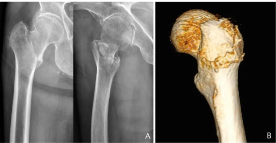 Figure 1. Simple radiograph of a basicervical femoral fracture patient. In the anterior-posterior view, the fracture is seen as a 2-part fracture, and in the lateral view, the fracture comminution of the great trochanter is not clearly visible (A)