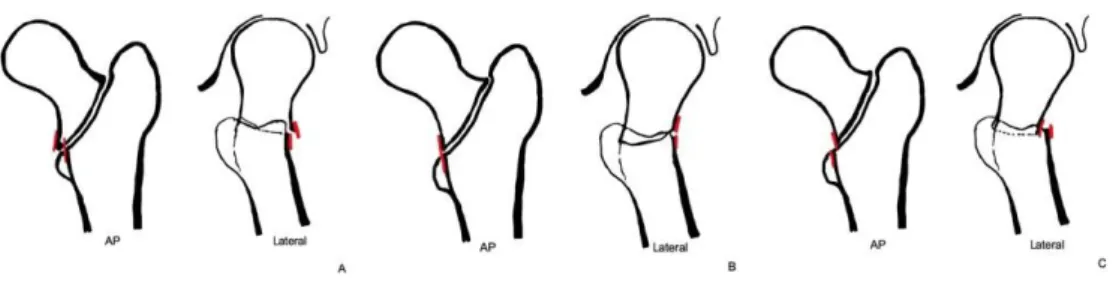 Figure 2. Illustration for classifying the reduction states in the AP and lateral view separately