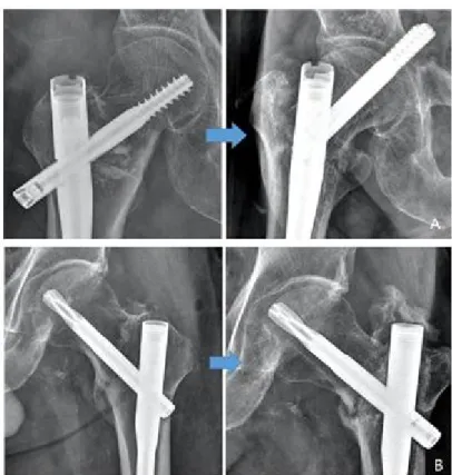 Figure 3. Two types of failure observed in basicervical fractures. Cut through or cut out of the lag screw (A)