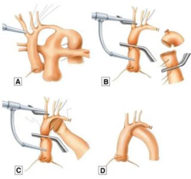 Figure 2 : (A) An atrial cannula is inserted at the innominate artery to maintain  cardiopulmonary bypass during extensive dissection