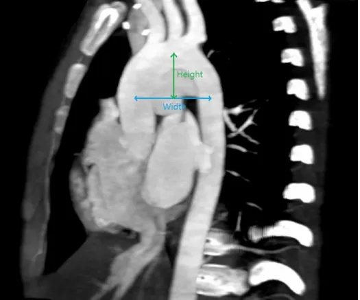 Figure  4  :  Height/width  (H/W)  of  the  arch  was  measured  based  on  the  CT  images