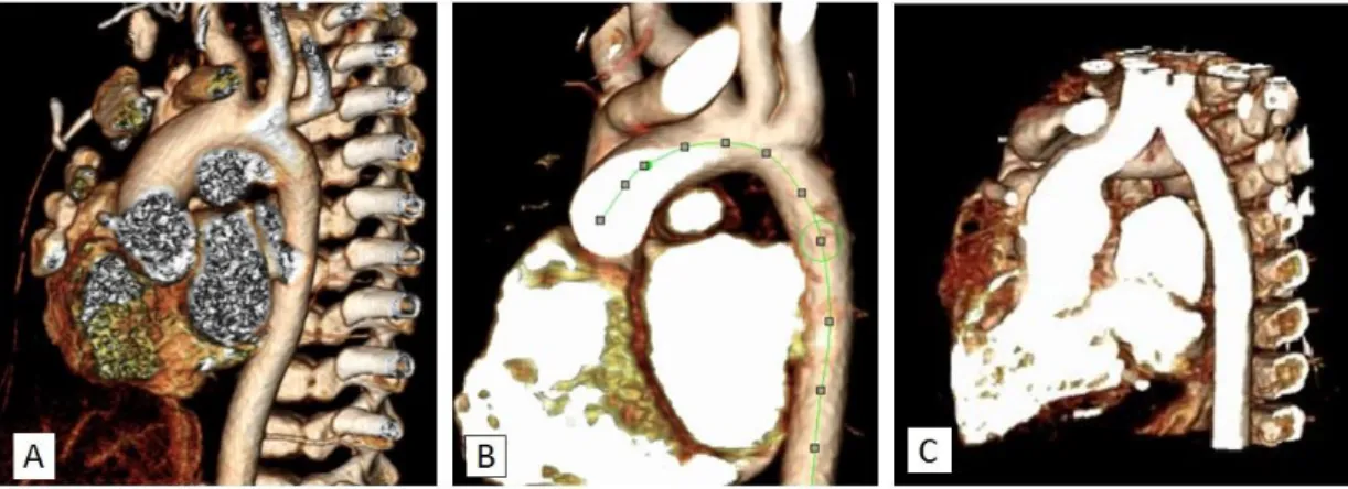 Figure  3  :  The  geometry  of  the  aortic  arch  was  classified  as  (A)  roman,  (B)  crenel or (C) gothic based on its shape