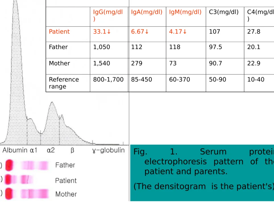 Fig.  1.  Serum  protein  electrophoresis  pattern  of  the  patient and parents.