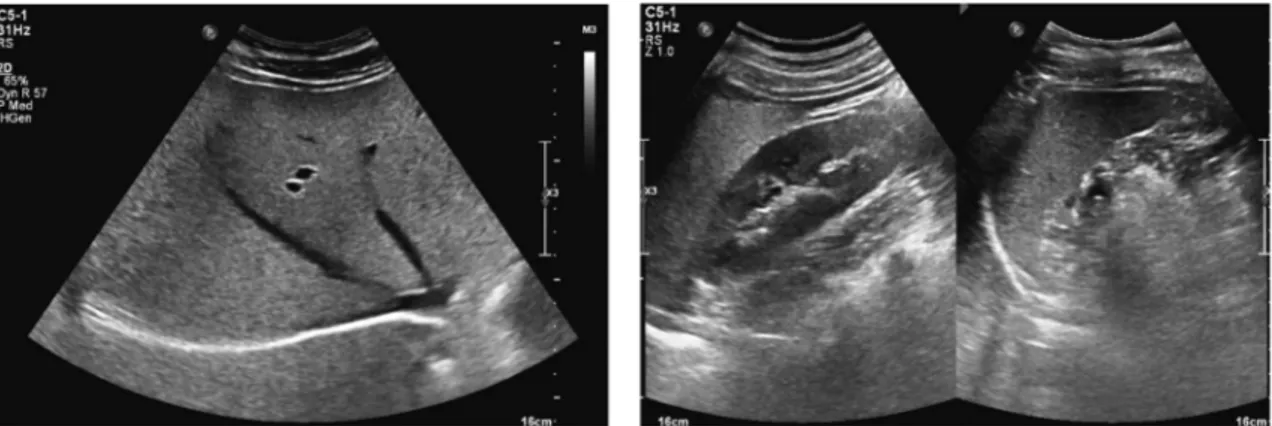 Fig. 2.  Grade I fatty liver by Ultrasonography. slightly diffuse increase in echogenicity of the hepatic parenchyma with normally visualized 