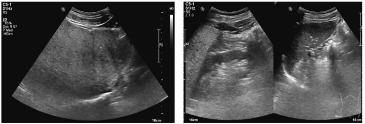 Fig. 4.  Grade III fatty liver by Ultrasonography. severe diffuse increase in echogenicity of the hepatic parenchyma with poorly visualized dia-