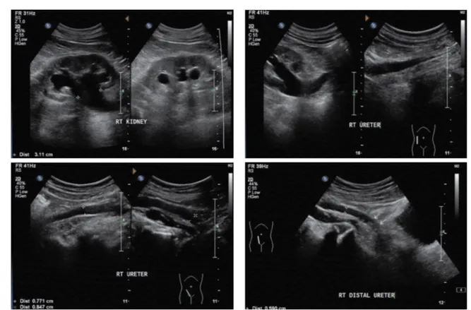 Fig. 1. Moderate hydronephrosis of right kidney, upper to middle hydroureter.