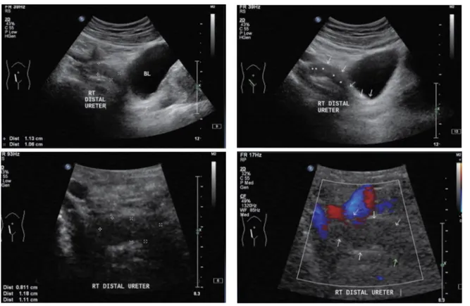 Fig. 2. A 67×11 cm hypoechoic mass in right distal ureter.