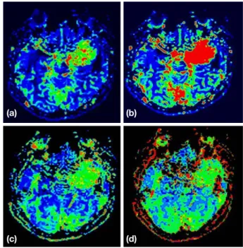 Fig. 6은 Frontal Tumor 관류자기공명영상이다. a는 좌, 
