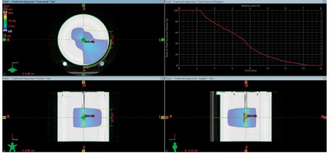 Fig. 1. GTV dose volume histogram with couch 90~180° rotation irradiation. Table 1. DVH values of GTV and normal tissue in couch rotation irradiation
