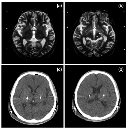 Fig. 3.   Deep brain stimulation surgery of pre-operative of axial T2-weighted MR image (a) and axial T2-weighthed image of subthalamic 