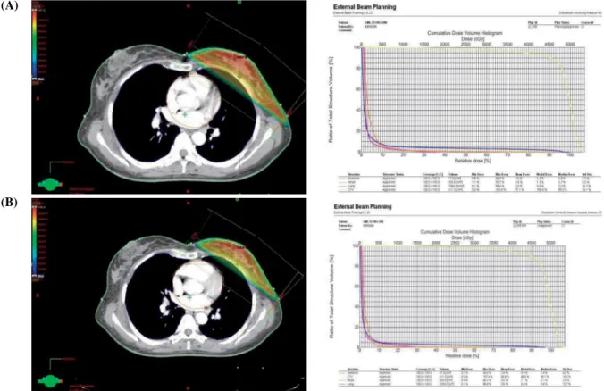 Fig. 2. Breast (30°) by applying the fixed wedge (A), dynamic wedge (B) comparison.