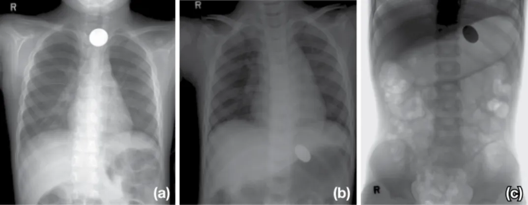 Fig. 2.   Chest radiograph of a 6-year-old male showed of aspirated foreign body in chest PA radiograph and 2 hour delayed abdominal fluo- fluo-roscopy spot image (b, c).