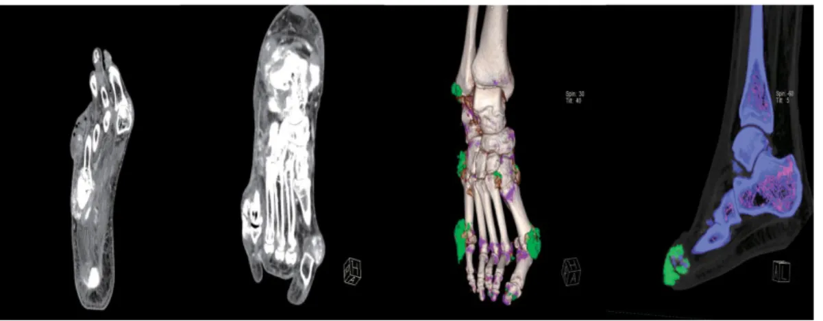 Fig. 5. Comparison of conventional Knee CT and DECT.Fig. 3. Comparison of conventional Foot CT and DECT.