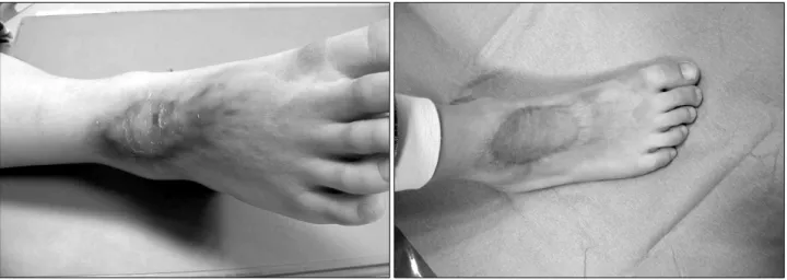 Fig. 1.  Case  1.  (Left)  A  6  year-old  boy  who  has  a  burn  scar  contracture  on  the  right  ankle  dorsum  after  third  degree  burn