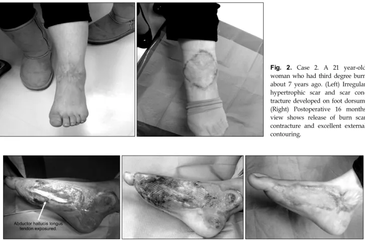 Fig. 2.  Case  2.  A  21  year-old  woman  who  had  third  degree  burn  about  7  years  ago