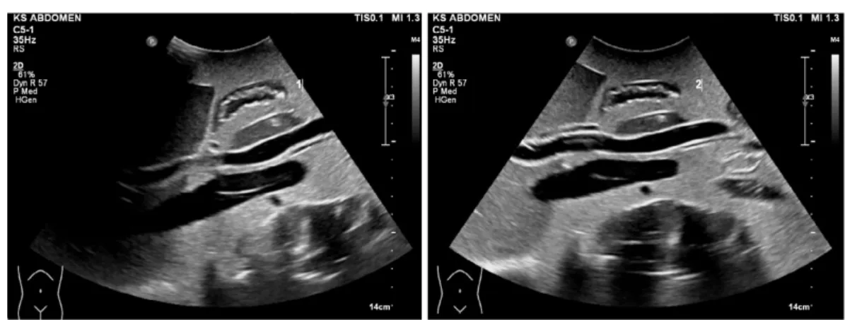 Fig. 2. Imaging of head of pancreas of abdominal ultrasound. 