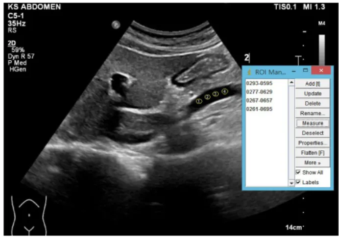 Fig. 9. ROI measurement of pancreatic head in image J program. Fig. 10.   Background measurement of pancreatic head in image J  program.