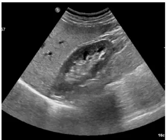 Fig. 1.   A 54-year-old male with fatty liver, that was not found on 