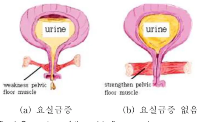 그림 1. 골반저근의 비교 항문거근 중 치골미골근 부위가 수축하면 그 길이가 짧아지고 두꺼워져 골반저근의 구멍이 가로로 좁아지고, 아울러 전후 직경이 줄어들어골반장기를 위로 밀어 올려준다