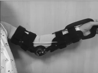 Fig. 1.  Dynamic  elbow  flexion  orthosis  -  dynamic  force  by  rubber  band  with  joint  of  limited  motion  brace  (case  1).