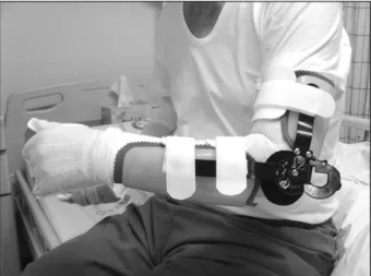 Fig. 2.  dynamic  elbow  flexion  orthosis  -  dynamic  force  by  spring  of  limited  motion  brace  joint  (case  2).