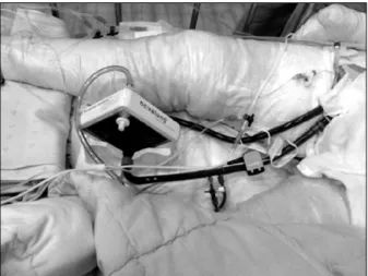 Fig. 1. A  patients  with  ARDS  treated  by  Interventional  Lung  Assist  system  (iLA).