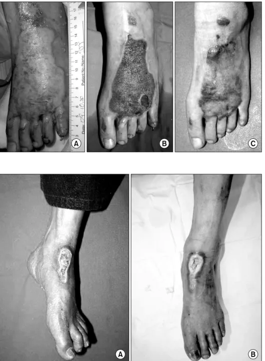 Fig. 2.  Patient  4.  (A)  A  10  year  old  patient  presented  chronic  soft  tissue  defect  of  dorsum  of  foot  due  to  traffic  accident