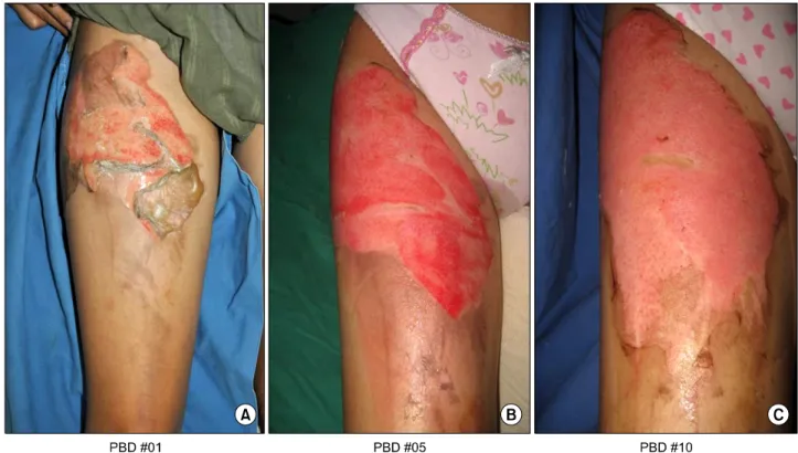 Fig. 3.  Patient  2.  (A)  A  16  year  old  female  presented  with  deep  second  degree  scalding  burn  at  right  thigh