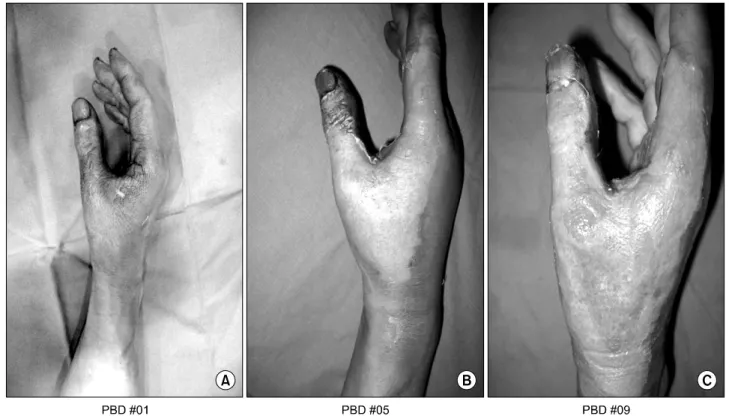 Fig. 4.  Patient  3.  (A)  A  54  year  old  male  presented  with  deep  second  degree  spark  burn  at  right  thigh