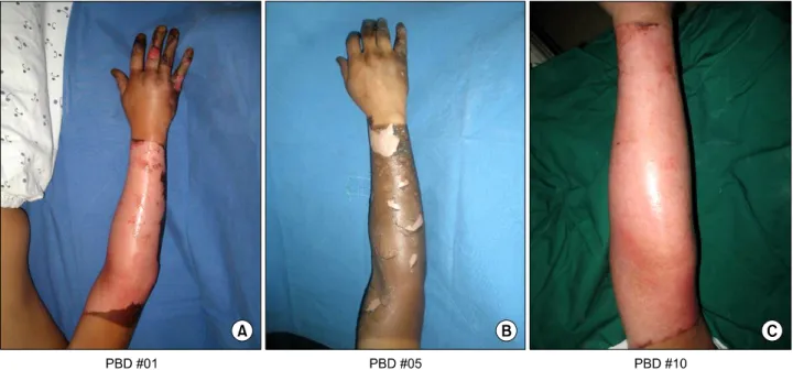 Fig. 6. Patient  5.  (A)  A  42  year  old  male  presented  with  deep  second  degree  flame  burn  at  right  hand