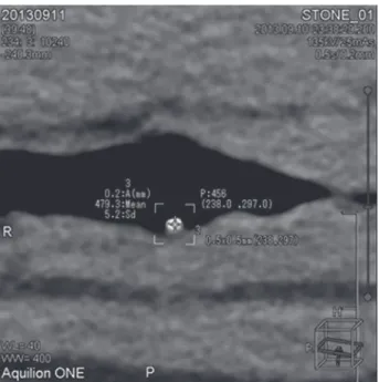 Fig. 2.   Measurement of HU using the pork inserted urinary stone 