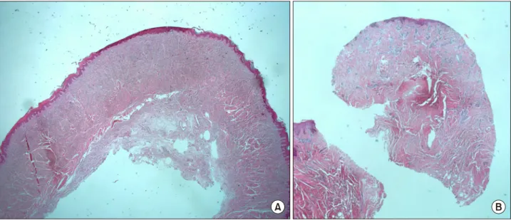 Fig. 5.  (A)  Intraoperative  pathologic  photograph  showing  2.8  mm  thickness  dermis