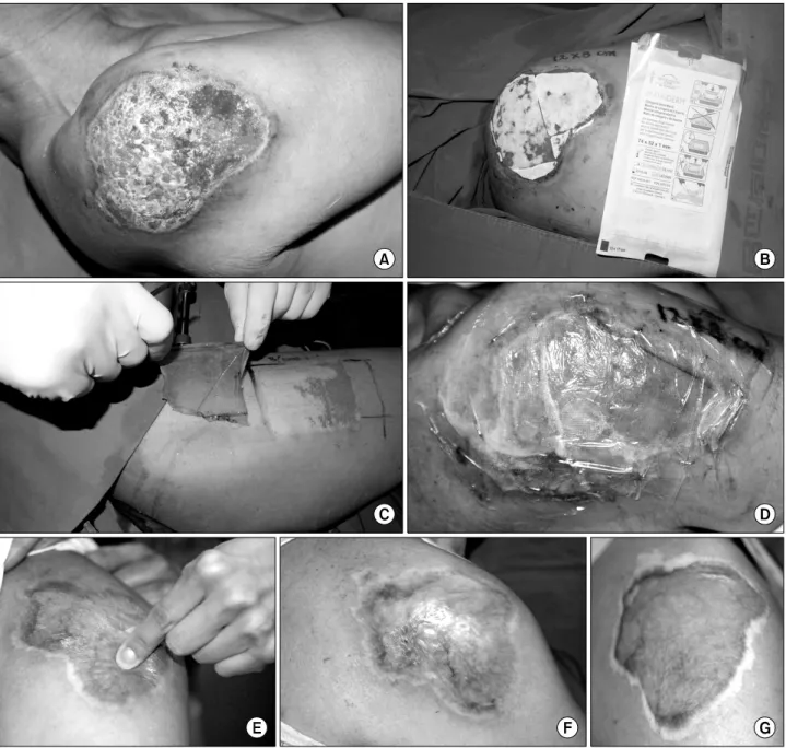 Fig. 1.  (A)  The  60  year-old  male  patient  sustained  from  the  contact  thermal  burn  in  his  right  shoulder