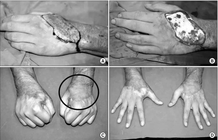 Fig. 3.  (A)  This  17  year-old  male  patient  suffered  from  the  deep  2∼3rd  degree,  30%,  flame  burn,  both  hands  and  extremities