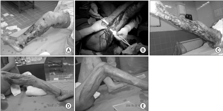 Fig. 1.  Clinical  case  (occurred  on  Rt.  leg).  (A)  Initially  small  contact  burn  wound  on  Rt