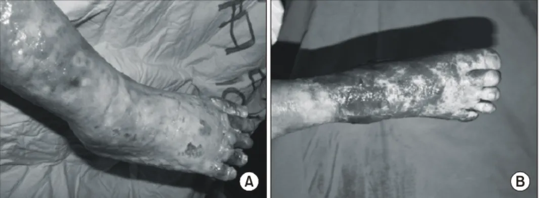 Fig. 4.  Dressing  method,  Duo- Duo-derm  and  zinc  oxide  oint  apply  on  wound  margin  (A),  and  then  a  net  is  applied  on  wound  (B).