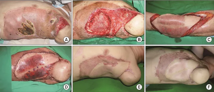 Fig. 3.  (A,  B)  4th  degree  burn  wound  on  chest  wall  was  initially  treated  by  skin  graft  but  soft  tissue  necrosis  and  osteomyelitis  on  rib  occurred